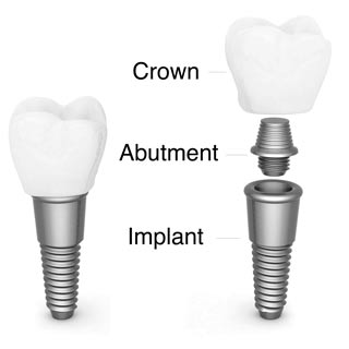 get-dental-implants-in-sydney