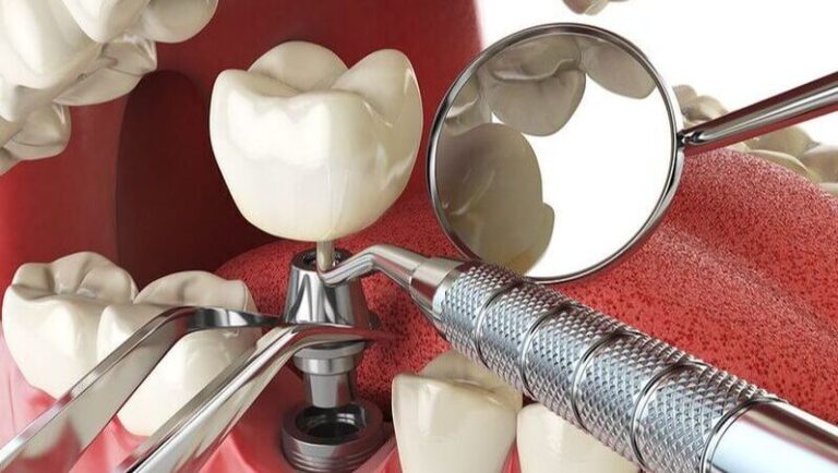 Key Benefits of Dental Implants for Seniors