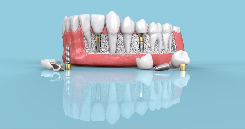 Dental Implants - The Best Teeth Replacement Option