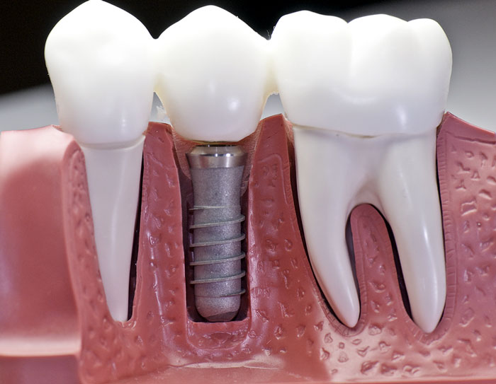 dental implants in Thailand