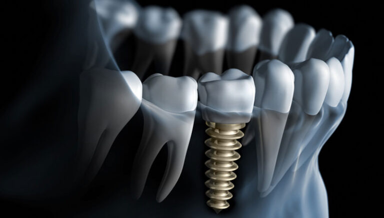 Top Factors Influencing the Dental Implants Cost