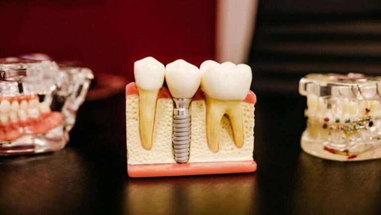Tips To Have Affordable Dental Implants in Sydney