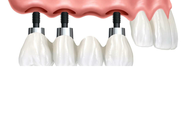 Dental Implants Sydney | Digital dental implants