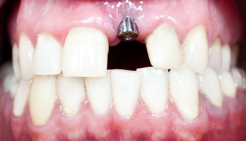 Dental implants in Melbourne