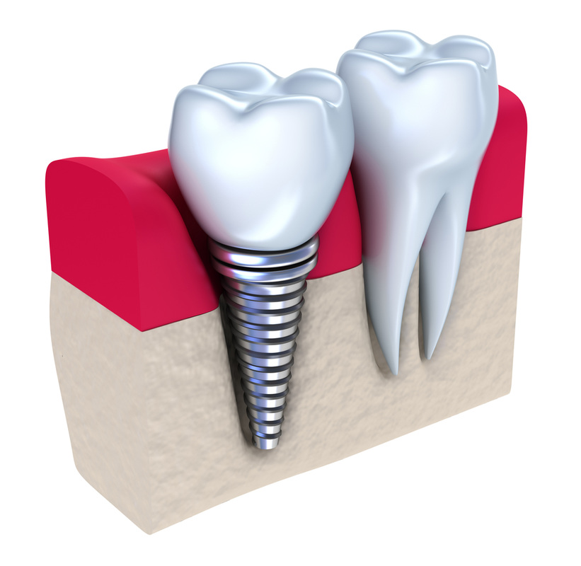 Sydney dental implants
