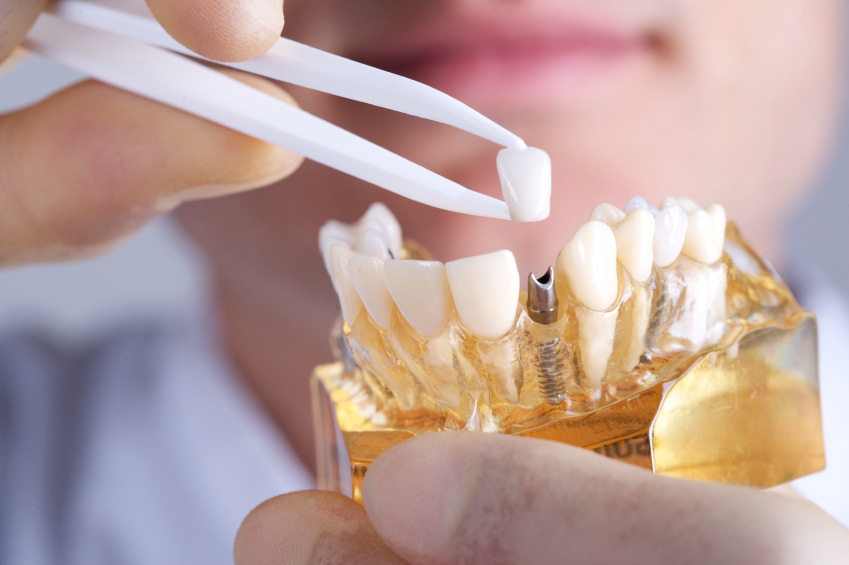 Teeth implants in Sydney