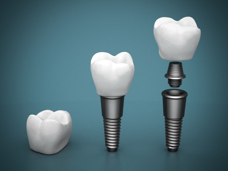 affordable dental implants sydney