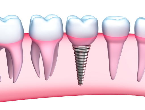 affordable-dental-implants-in-sydney
