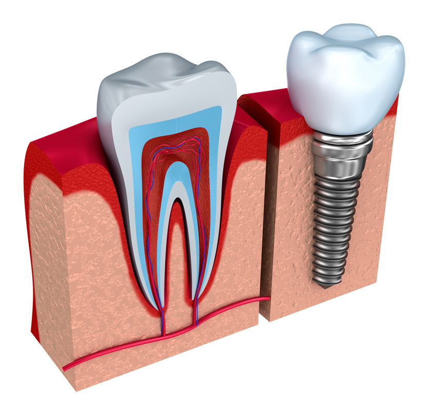 all-on-4-dental-implants_orig