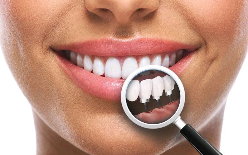 an-extensive-guide-to-dental-implants-cost-in-sydney