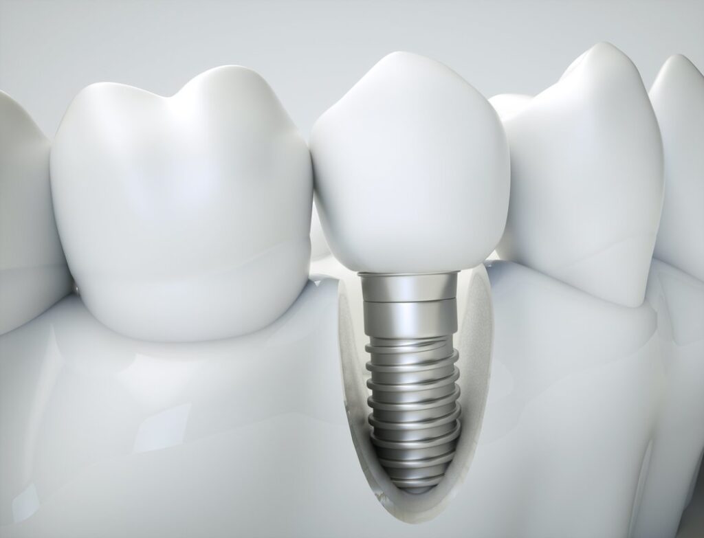are-dental-implant-procedures-comfortable