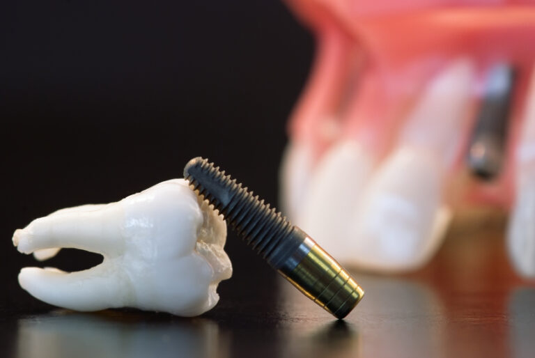dental implants price
