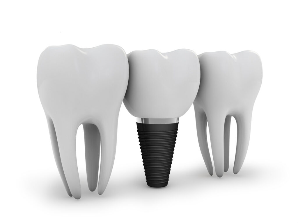 basic-information-about-dental-implants_orig