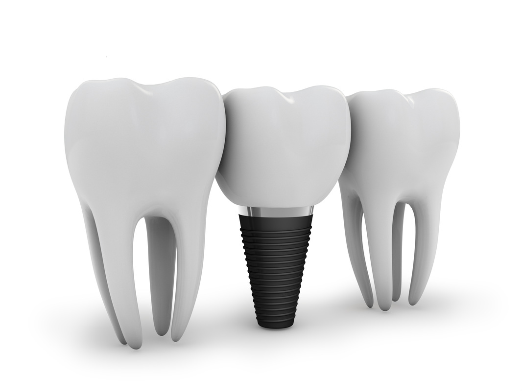 Basic Information about Dental Implants DENTAL IMPLANTS SYDNEY