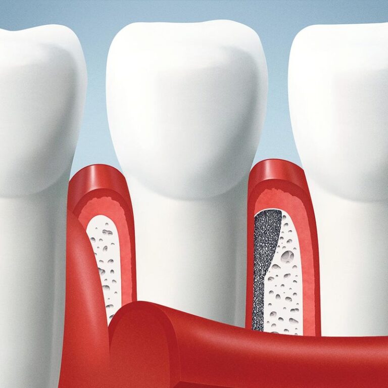 bone-graft-essential-for-dental-implants_orig