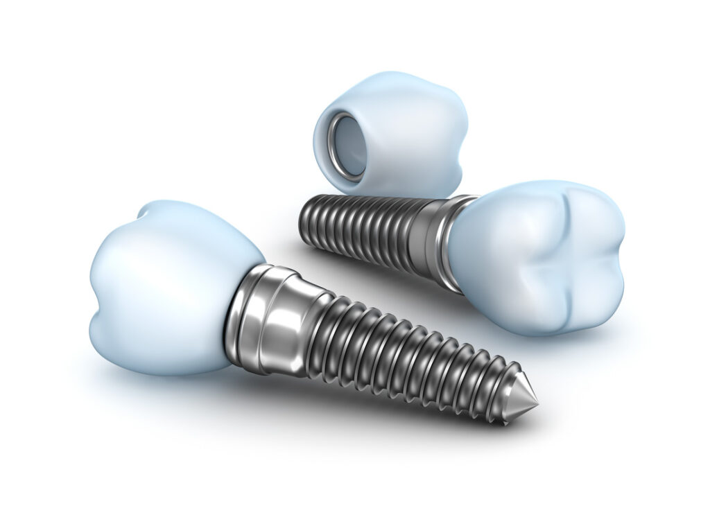 changing-trends-in-dental-implants_orig
