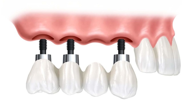 cheap dental implants in sydney