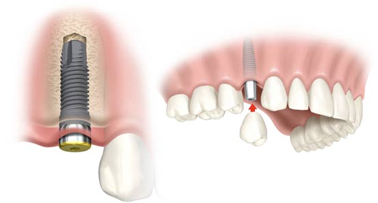 cheap dental implants in Sydney