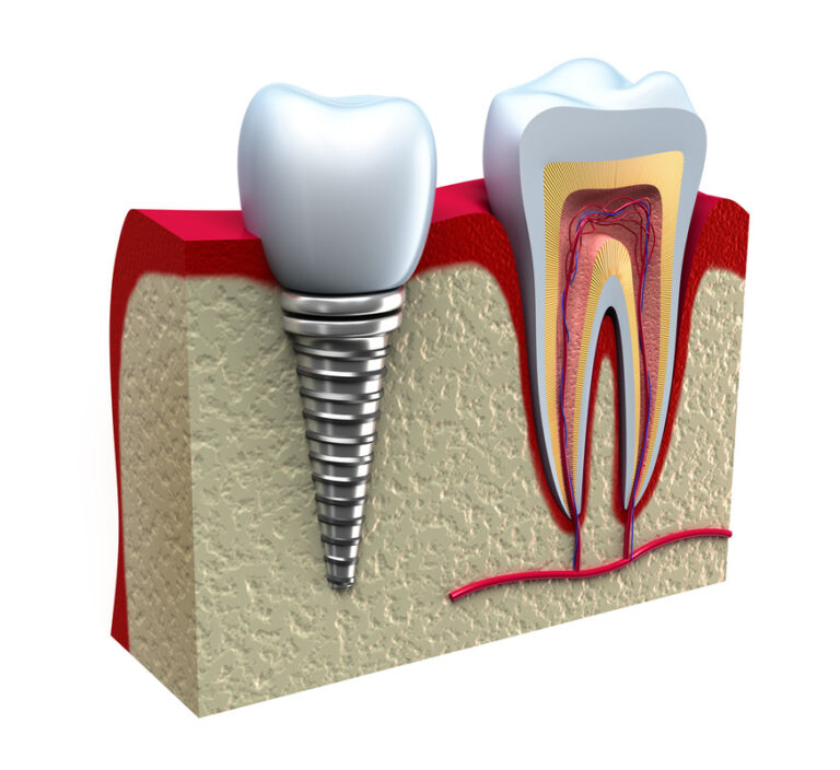 complications-with-dental-implant_orig