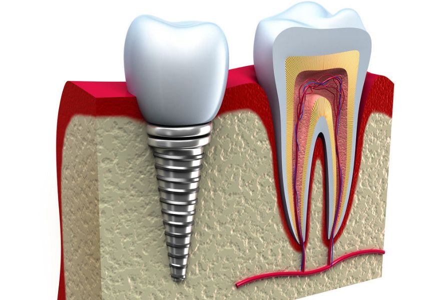 dental-implant-