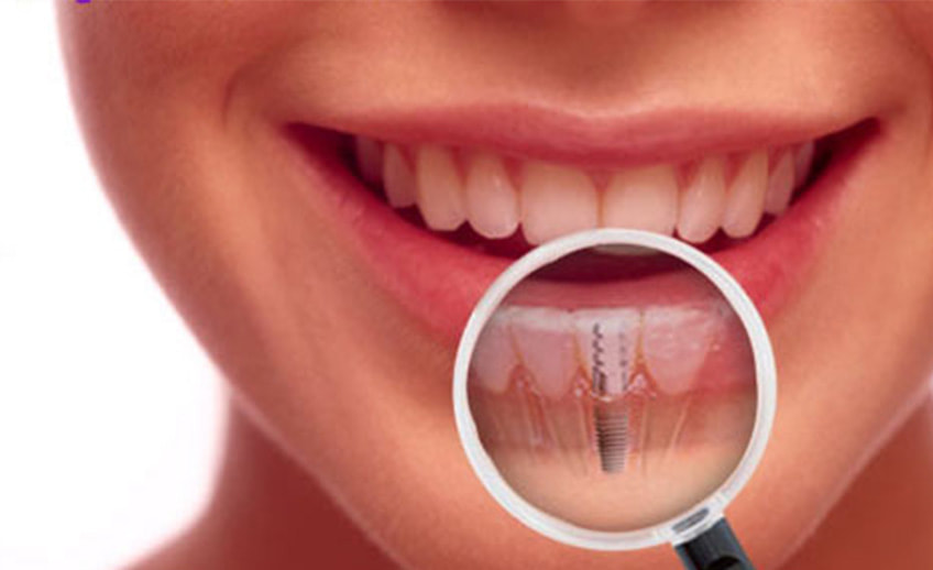dental-implant_1_