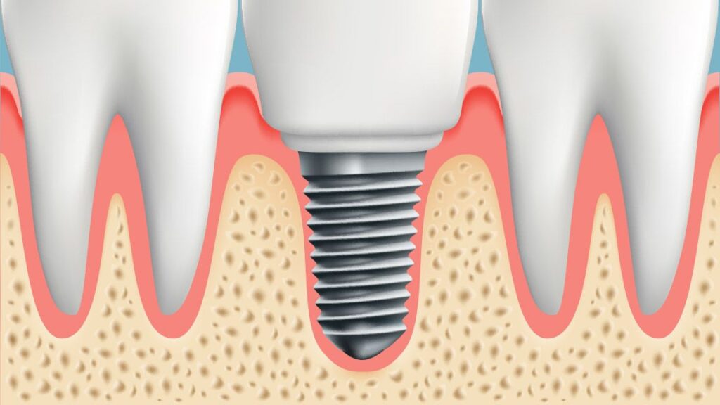 dental-implants-all-you-ought-to-know