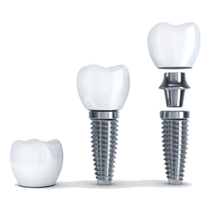 DENTAL IMPLANTS | Dental Implants COST In Melbourne