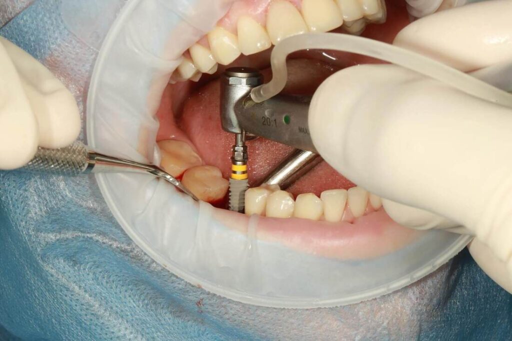 dental-implants-in-melbourne_orig