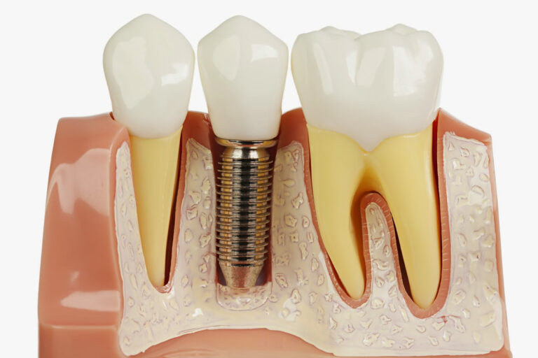 dental-implants-myths