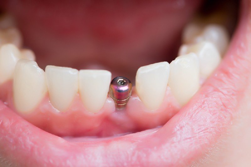 dental-implants-one-stop-solution-for-your-missing-tooth
