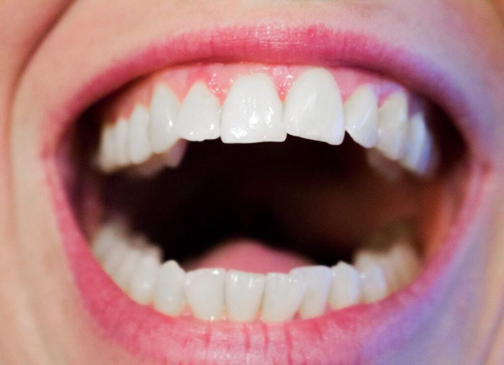 dental-implants-over-dentures_