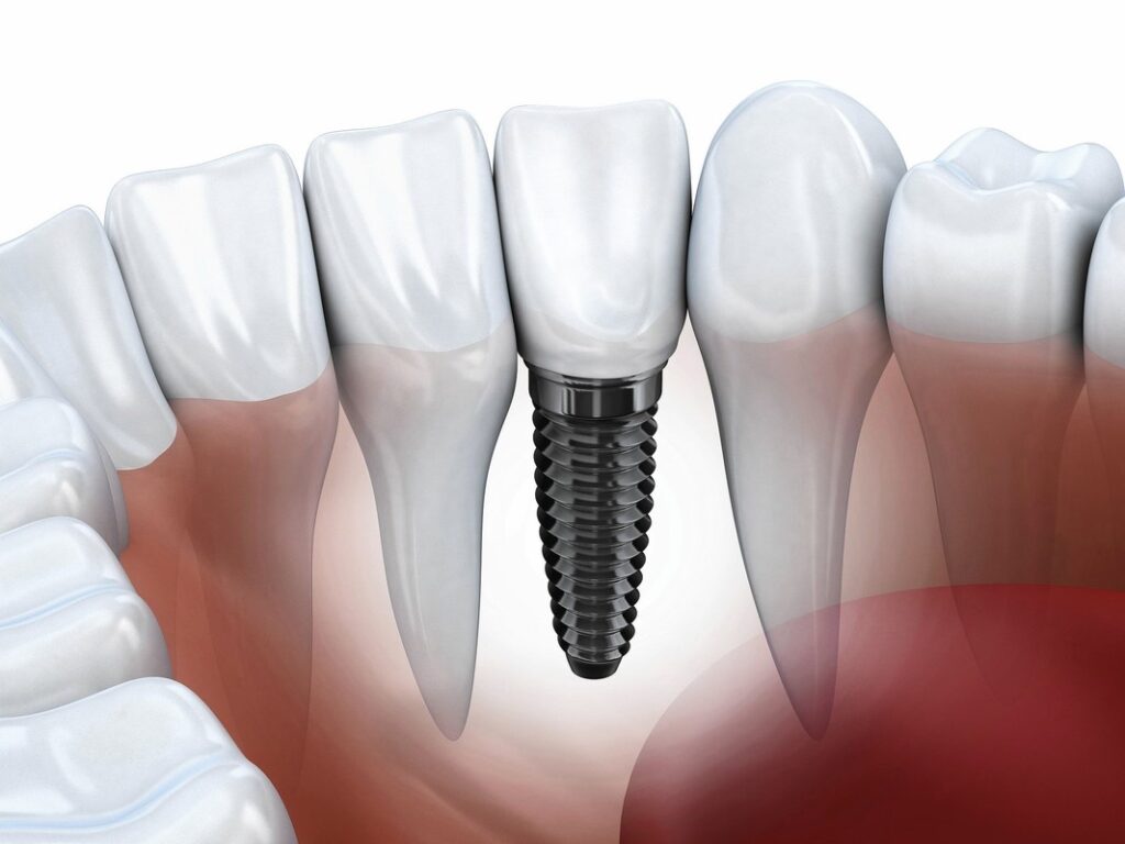 dental-implants-that-are-actually-false