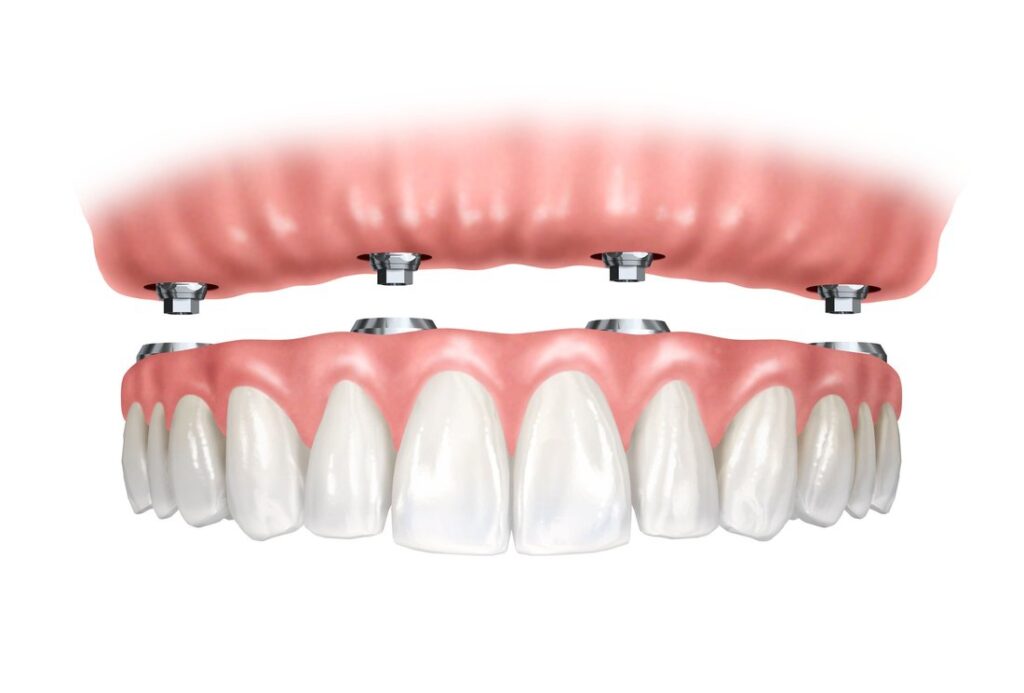 dental-implants-vs-dentures