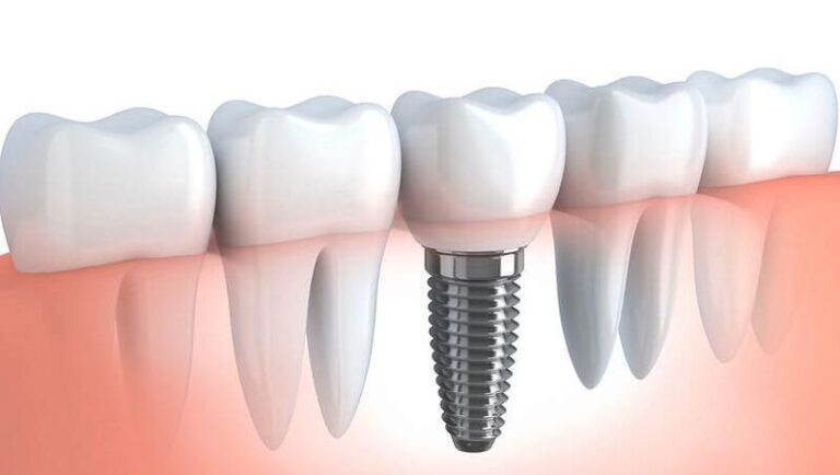 What are the Common Misconceptions to Avoid with All-on-4 Dental Implants?