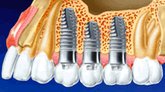 dentalimplant