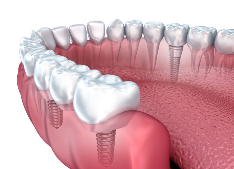 frequently-asked-questions-on-dental-implants-answered