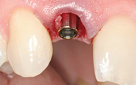immediate dental