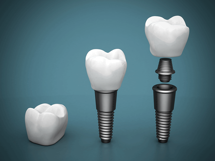 Dental Implants Melbourne | Dental Implant Professionals