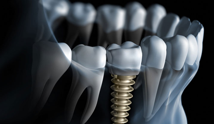 procedure-details-of-dental-implant
