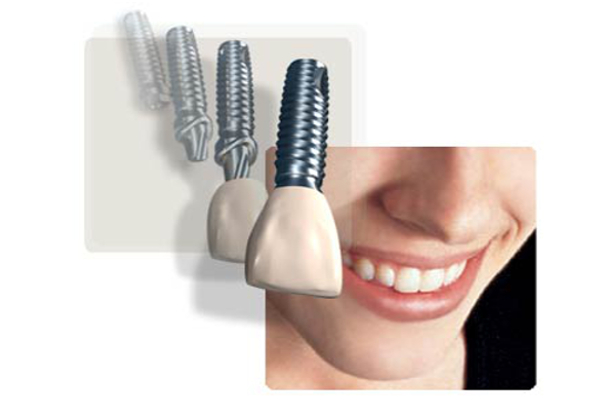 teeth implants in Sydney