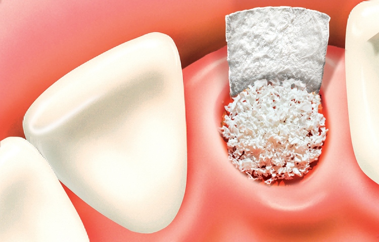 bone graft for dental implants
