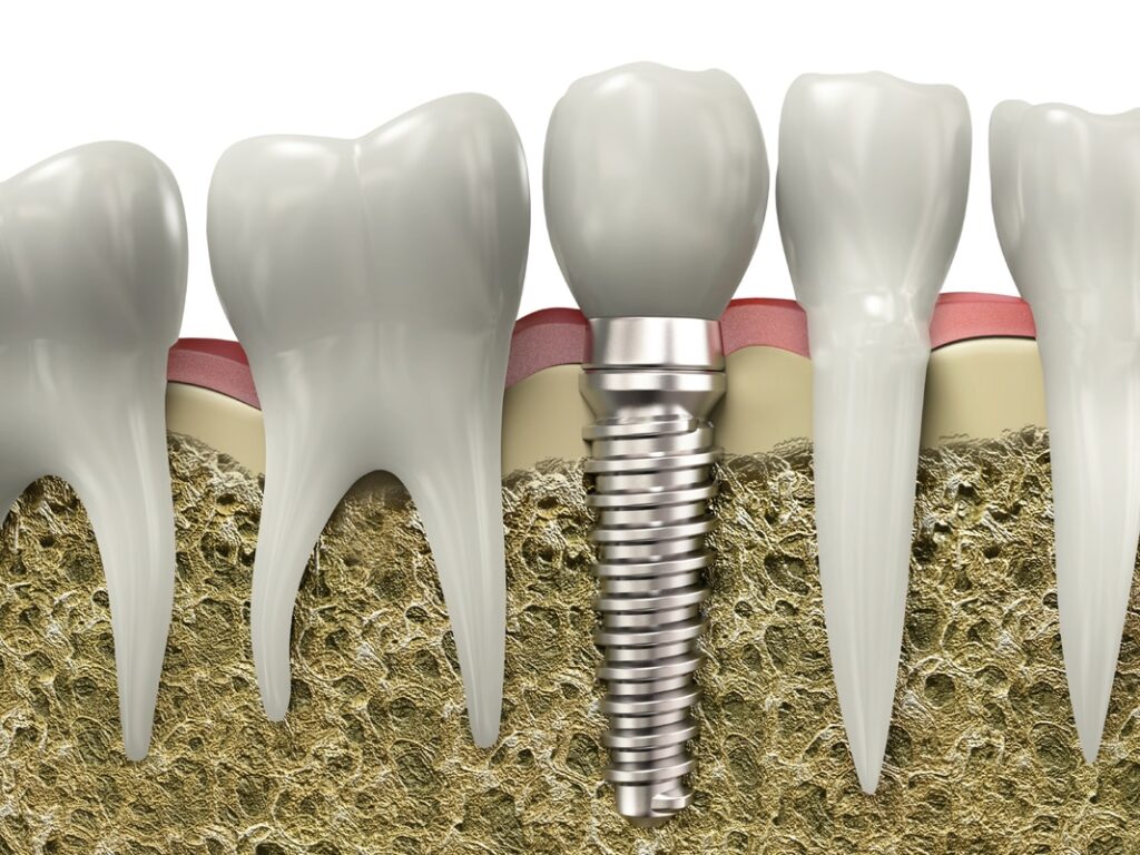 typical-dental-implant-cost-in-sydney