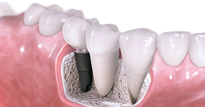 ultimate-guide-on-dental-implant