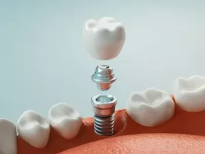 Dental Implants Procedure