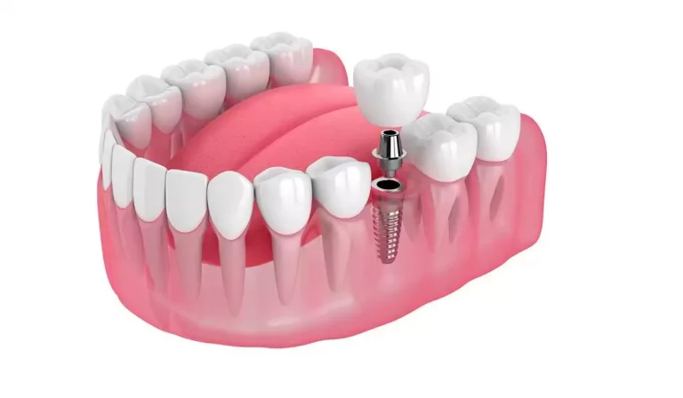 Dental Implants in Sydney: Costs, Procedures, and Benefits