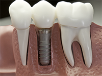 artificial tooth roots