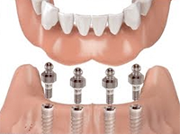 best dental implant