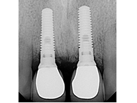 best tooth implant