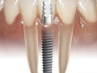 replace lost tooth roots