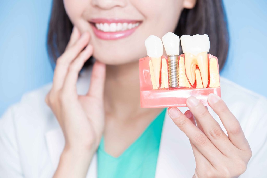 dental implants recovery -Dental Implants Professionals-sydney